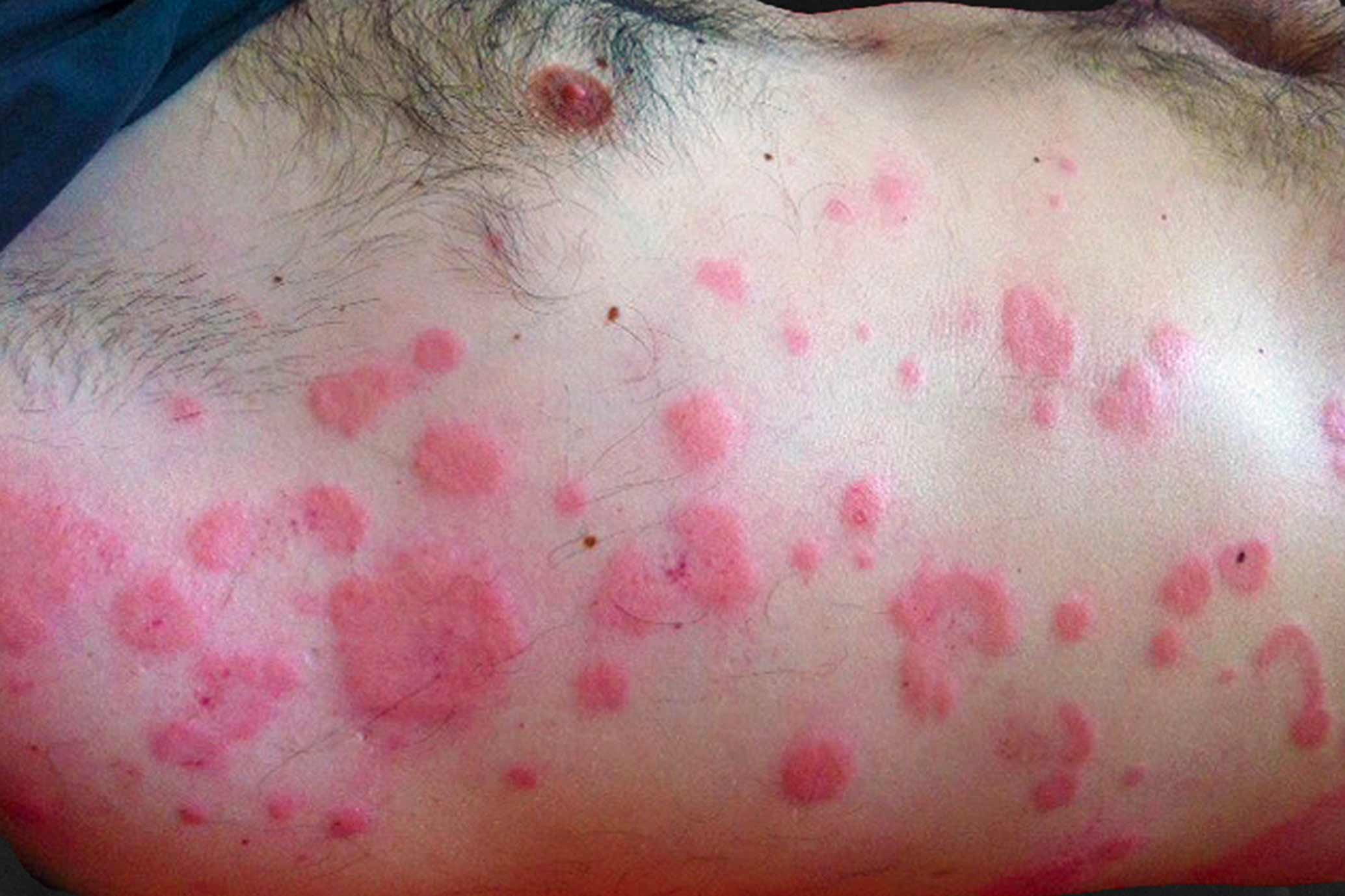 Macchie Rosse sulla Pelle cause e rimedi Eucerin